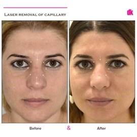 LASER TREATMENT OF CAPILLARY - Before and After