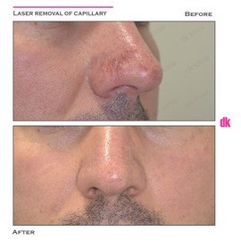 LASER TREATMENT OF CAPILLARY - Before and After
