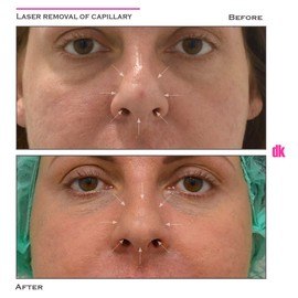 LASER TREATMENT OF CAPILLARY - Before and After