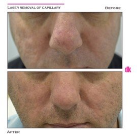 LASER TREATMENT OF CAPILLARY - Before and After