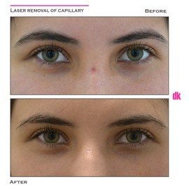 LASER TREATMENT OF CAPILLARY - Before and After