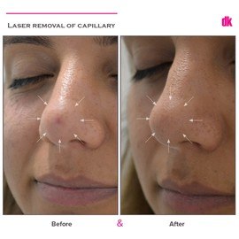 LASER TREATMENT OF CAPILLARY - Before and After