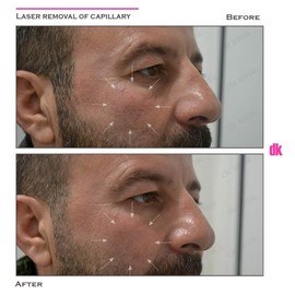 LASER TREATMENT OF CAPILLARY - Before and After