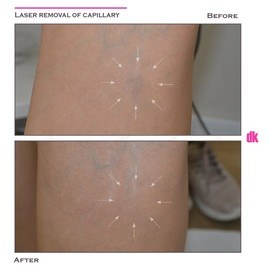 LASER TREATMENT OF CAPILLARY - Before and After
