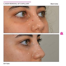 LASER TREATMENT OF CAPILLARY - Before and After