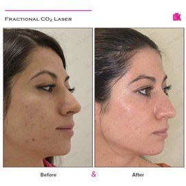 ACNE SCAR TREATMENT - Before and After