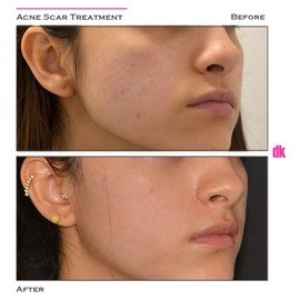 ACNE SCAR TREATMENT - Before and After