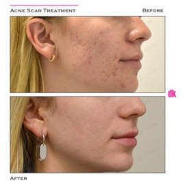 ACNE SCAR TREATMENT - Before and After
