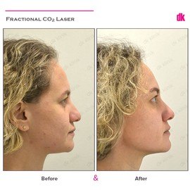 ACNE SCAR TREATMENT - Before and After