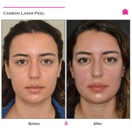 ACNE SCAR TREATMENT - Before and After