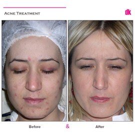 ACNE TREATMENT - Before and After