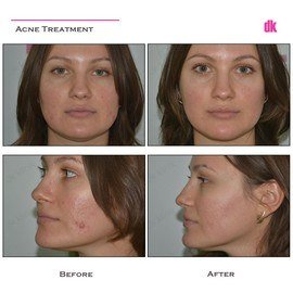 ACNE TREATMENT - Before and After