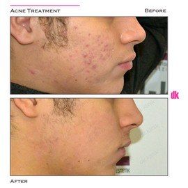 ACNE TREATMENT - Before and After