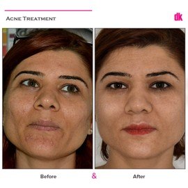 ACNE TREATMENT - Before and After
