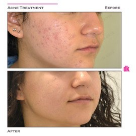 ACNE TREATMENT - Before and After