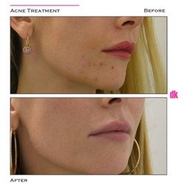 ACNE TREATMENT - Before and After