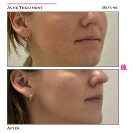 ACNE TREATMENT - Before and After