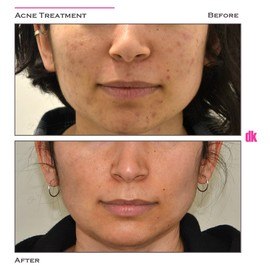 ACNE TREATMENT - Before and After