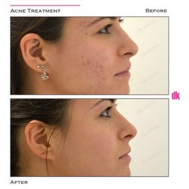 ACNE TREATMENT - Before and After