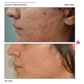 ACNE TREATMENT - Before and After