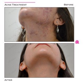 ACNE TREATMENT - Before and After