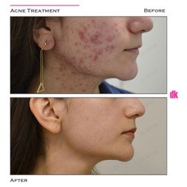 ACNE TREATMENT - Before and After