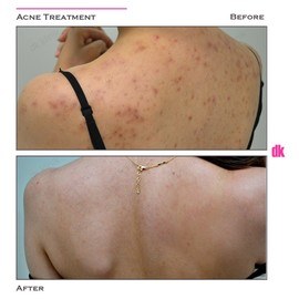 ACNE TREATMENT - Before and After