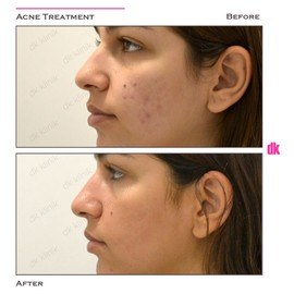 ACNE TREATMENT - Before and After