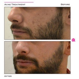 ACNE TREATMENT - Before and After