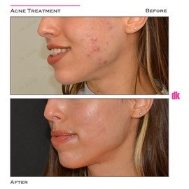 ACNE TREATMENT - Before and After