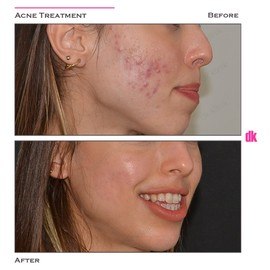 ACNE TREATMENT - Before and After