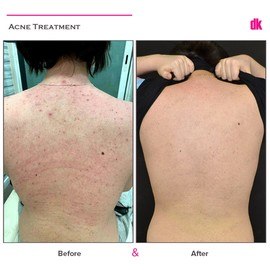 ACNE TREATMENT - Before and After