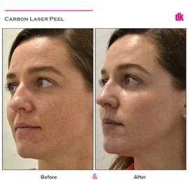 CARBON PEELING - Before and After