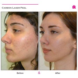 CARBON PEELING - Before and After
