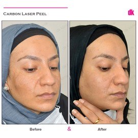 CARBON PEELING - Before and After