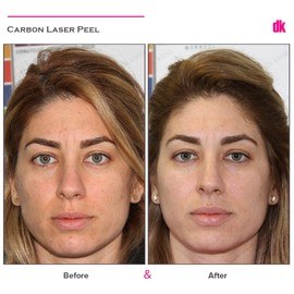 CARBON PEELING - Before and After