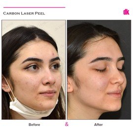 CARBON PEELING - Before and After