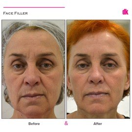 FILLER- Cheek - Before and After