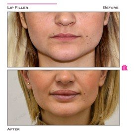 FILLER - Lip - Before and After