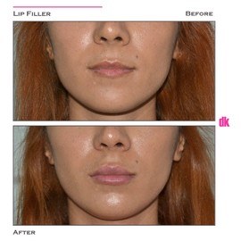 FILLER - Lip - Before and After