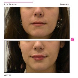 FILLER - Lip - Before and After