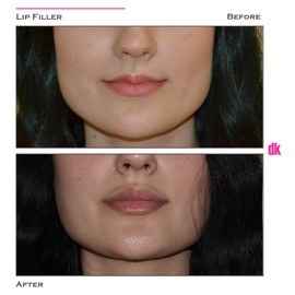 FILLER - Lip - Before and After