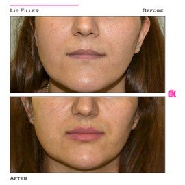 FILLER - Lip - Before and After