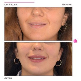 FILLER - Lip - Before and After