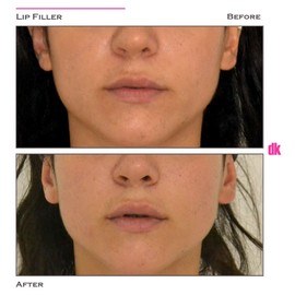 FILLER - Lip - Before and After