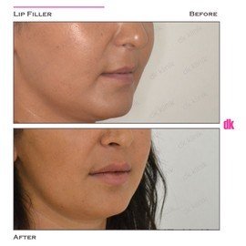FILLER - Lip - Before and After