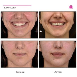 FILLER - Lip - Before and After