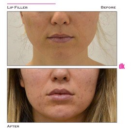 FILLER - Lip - Before and After