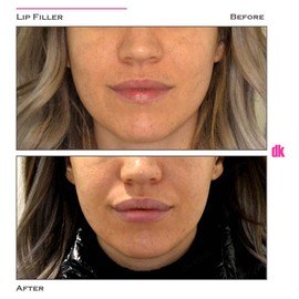 FILLER - Lip - Before and After