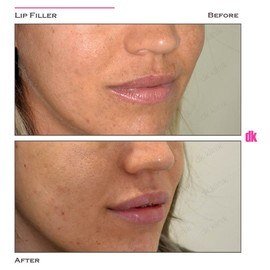 FILLER - Lip - Before and After